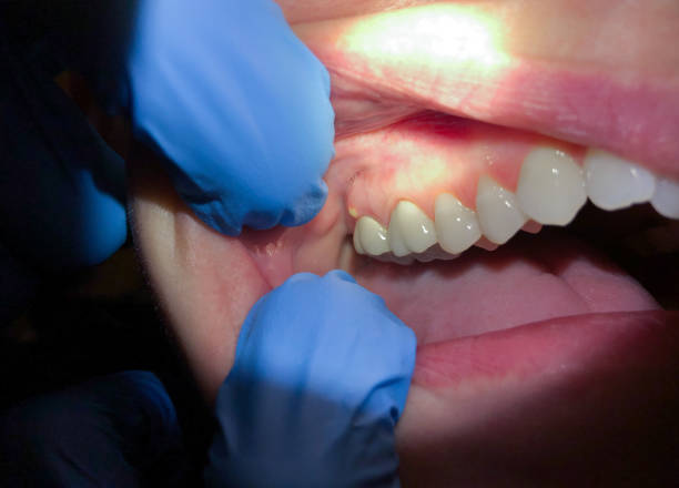 Best Emergency Dental Services for Seniors in Iowa City, IA