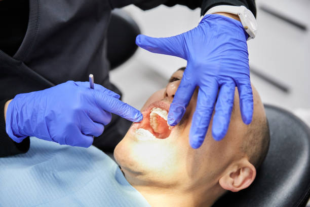 Best Emergency Root Canal Treatment in Iowa City, IA